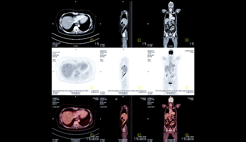 PET CT全身扫描图像