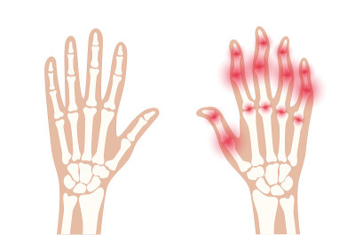 Arthrits