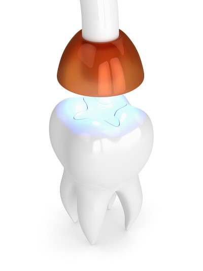 牙齿的3d渲染与牙齿聚合灯和光固化镶嵌