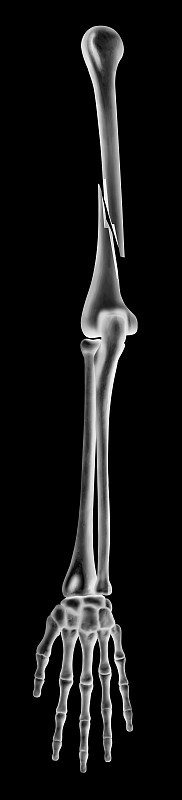 肱骨骨折或骨折手臂完全移位骨折的x线片类型-前视图- 3D医学-生物医学插图-医疗保健-黑色背景孤立