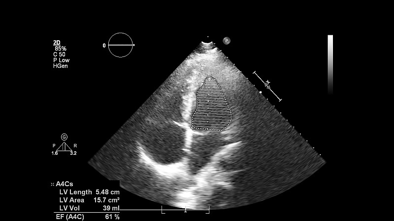 经食管超声检查心脏图像。