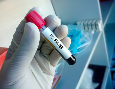 实验室甲状腺激素检查用试管血样。发生、FT4、TSH。甲状腺机能亢进或减退的诊断。实验室的背景。