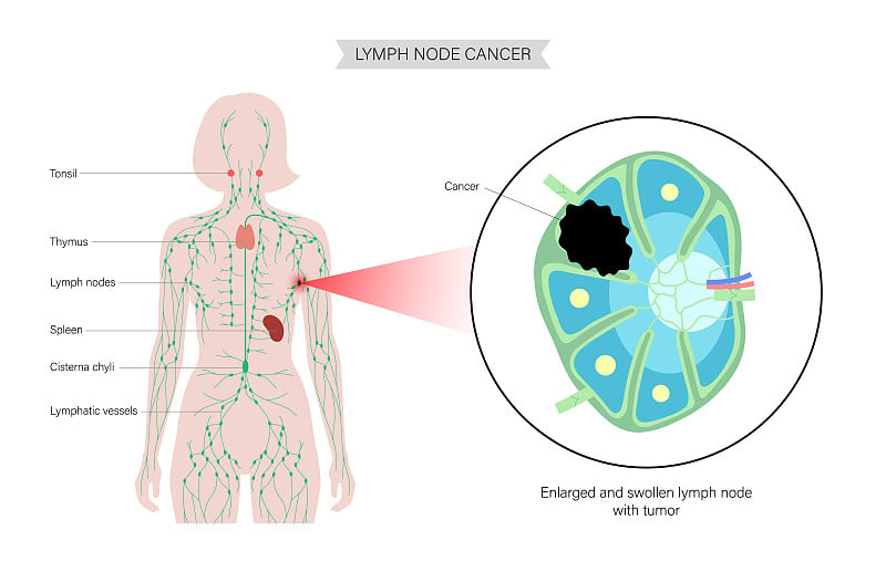 Lymphoma cancer concept