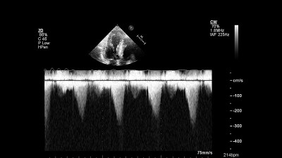 经食管超声检查心脏图像。