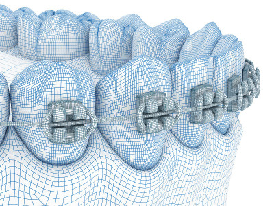 括号和假牙。Wire 3d模型插图