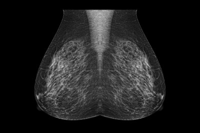 x射线数字乳房x线照片或乳房x线照片MLO视图筛查乳腺癌。