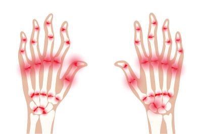 Arthrits