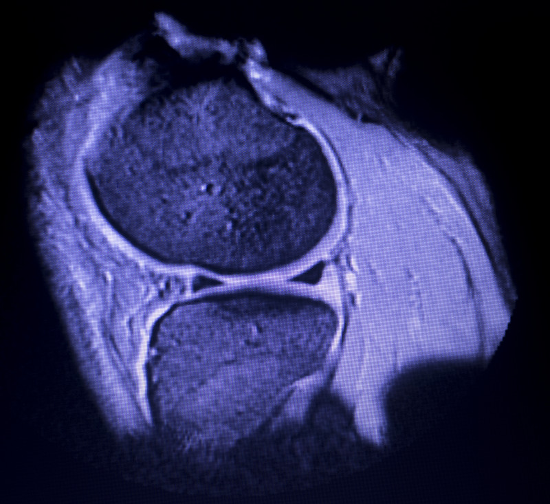 磁共振成像MRI膝关节后角内侧半月板撕裂的结果极少。