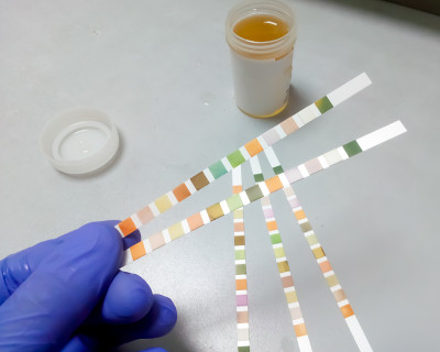 尿液分析试剂条，尿液常规分析，实验室检查分析