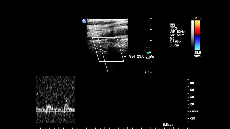 血管超声检查。