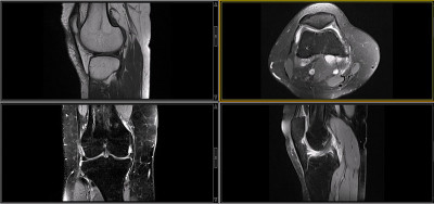 膝关节MRI(磁共振成像)