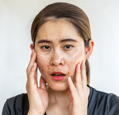 肖像亚洲妇女有问题的油性皮肤痤疮在她的脸上发炎。
