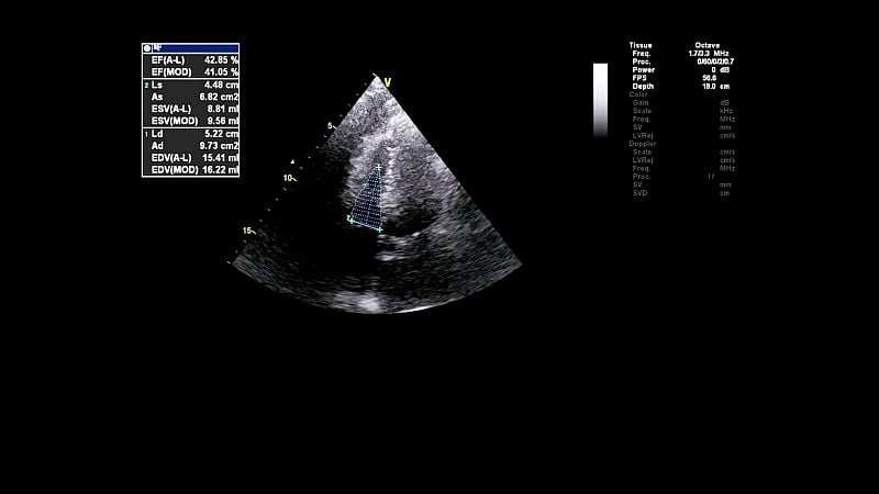 经食管超声检查心脏图像。