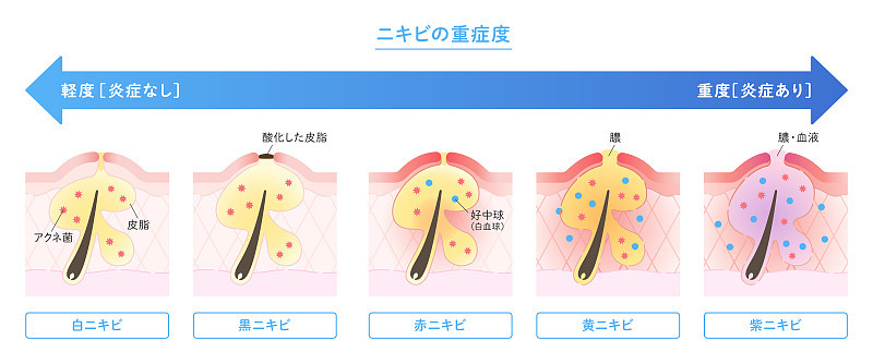 说明痤疮类型和严重程度显示在皮肤横断面