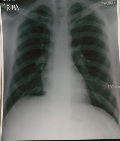 胸腔