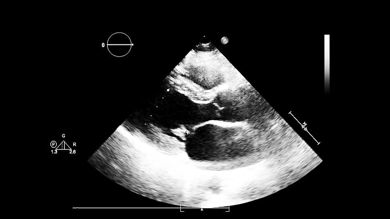 一个有心脏图像的超声波机器屏幕。