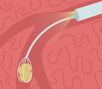 从唾液腺导管中取出结石。Sialendoscopy矢量插图。