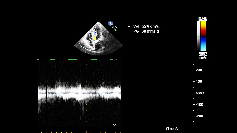 一个有心脏图像的超声波机器屏幕。
