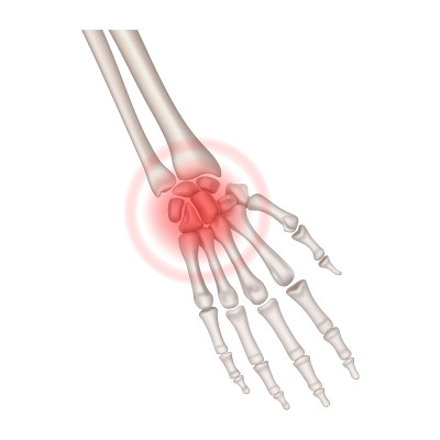 Human hand with inflammation of the carpometacarpa