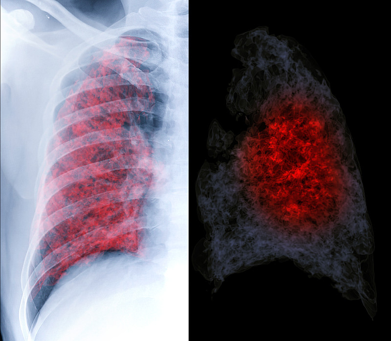 比较x线胸片和CT胸片3d显示covid-19肺部感染。