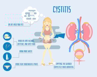 妇女抱尿肾脏和膀胱解剖，保健信息图，膀胱炎的概念