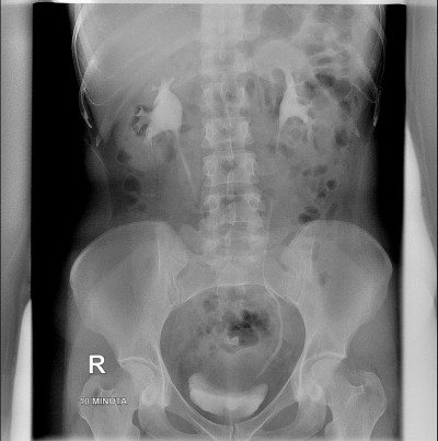 静脉urogram。仰卧位。输尿管没有狭窄的迹象。