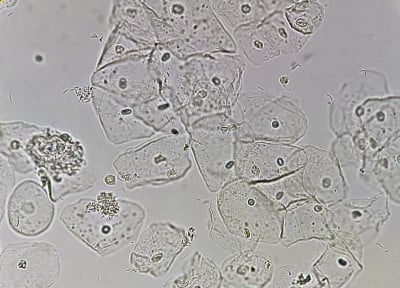 异常尿分析的显微镜近距离观察。上皮细胞，脓细胞，红细胞。100 x