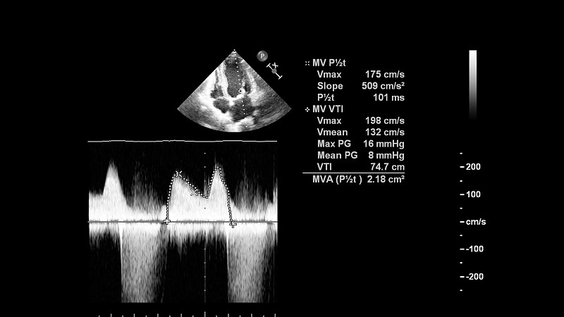 一个有心脏图像的超声波机器屏幕。