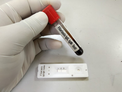 丝虫病抗体IgG、IgM快速检测试剂盒。结果IgG阳性。