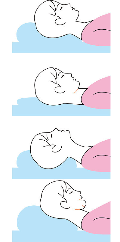 枕高导致下巴和颈部松弛