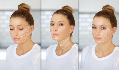 thread lift , nonsurgical procedure,lower facelift