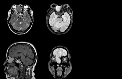 脑和眼眶MRI: 50岁女性，表现为急性头痛和右眼突眼。