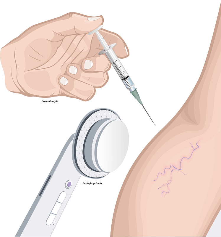 硬化疗法，或“应用”，是一种消除或减少静脉的治疗，从应用物质直接在该部位