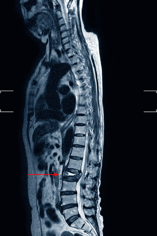 MRI ls -脊柱显示L2椎体爆裂骨折伴严重椎体塌陷，医学影像概念。