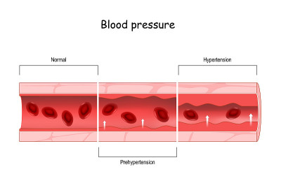 Hypertension. high blood pressure