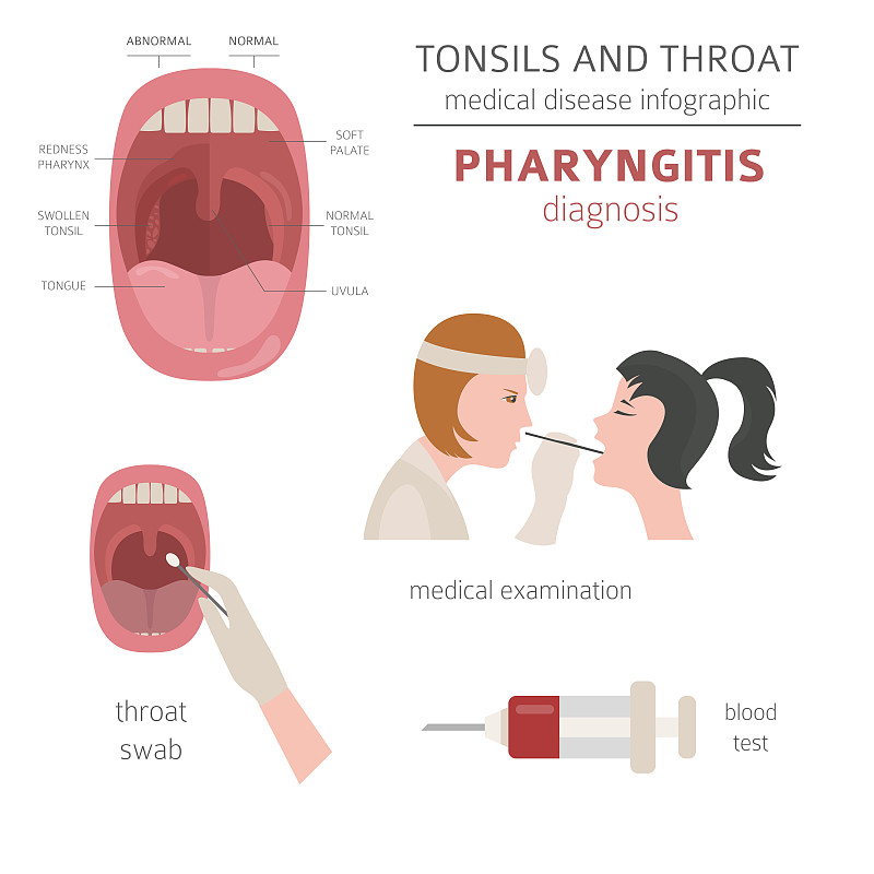 扁桃体和咽喉疾病。咽炎症状，治疗图标设置。医疗信息图表设计