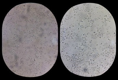 精子的形态。显微镜下精液照片。显微照片显示精子，正常精子症和无精子症与感染的比较。
