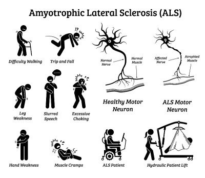 Amyotrophic lateral sclerosis ALS disease signs an