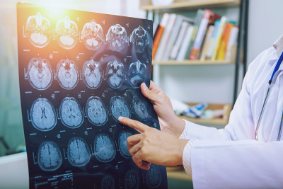 医生建议病人做MRI (x光)脑部扫描