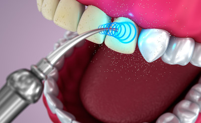牙齿美白，医学上准确的3D插图