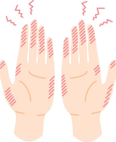 手和手指冻疮插图