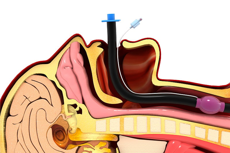 白色背景为气管插管。三维演示
