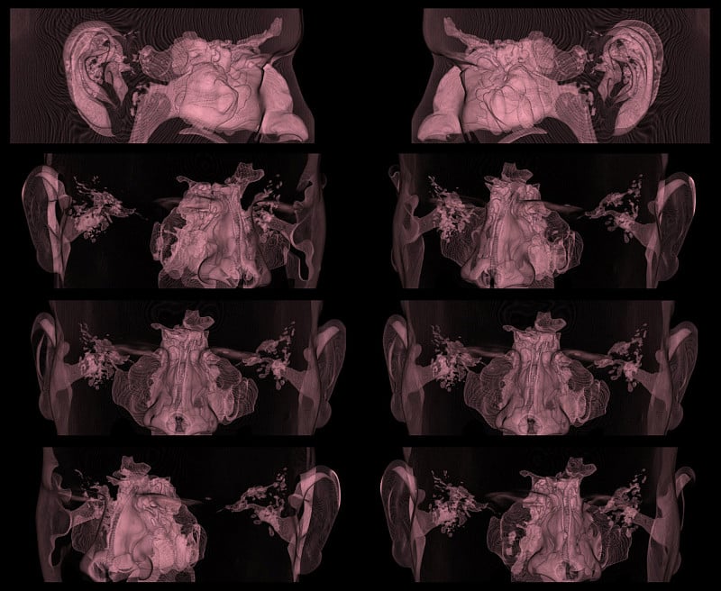 颞骨CT