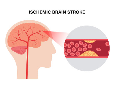 大脑stroke_ishemic