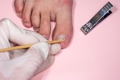 在粉红色背景上分离出甲骨溶解。戴着手套的医生用双手检查指甲的损伤情况。钉板有机械损伤。涂虫胶或凝胶漆
