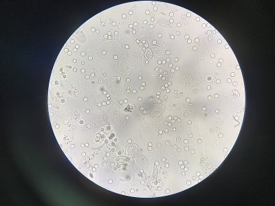 尿中有中度白细胞和细菌细胞。