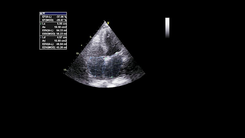 经食管超声检查心脏图像。