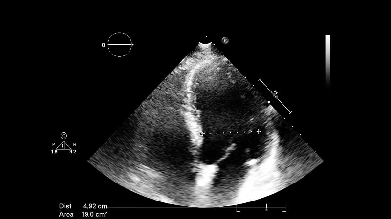 经食管超声检查心脏图像。