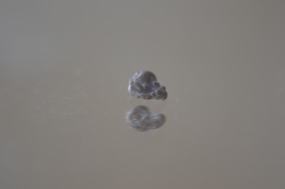 草酸钙肾结石
