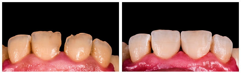 前牙直接复合修复